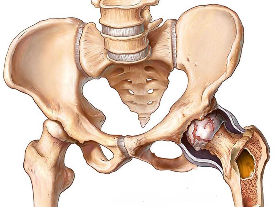 arthrose de la hanche