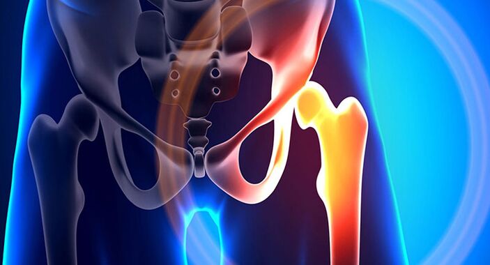 Les douleurs à la hanche sont le symptôme de nombreuses pathologies différentes. 
