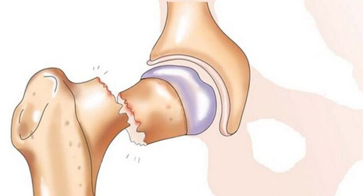 Une fracture du col fémoral s'accompagne de douleurs intenses au niveau de l'articulation de la hanche. 