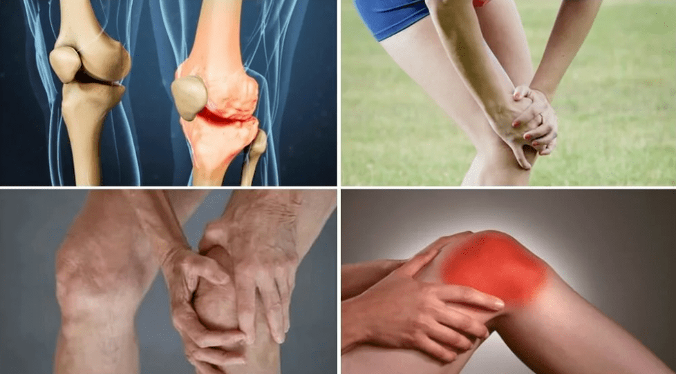 Symptômes de l'arthrose