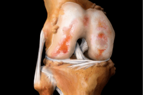 Dommages à l'articulation du genou dus à l'arthrose.